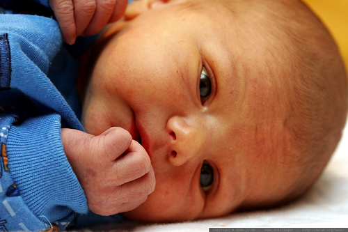 新生兒黃疸原因及治療