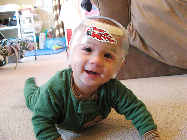 寶寶頭型何時固定 如何矯正?