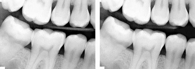 孕婦牙周病易引發早產機率