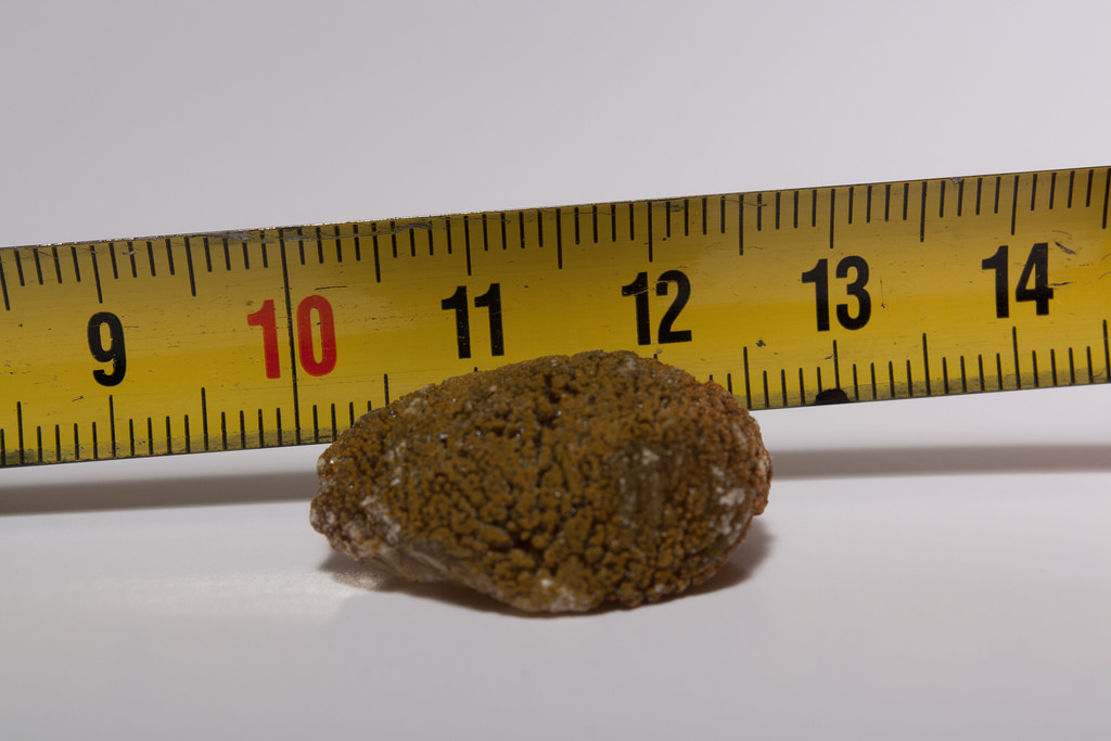 膽囊結石四百顆 全因吃太油