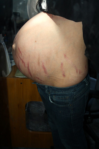 妊娠紋如何消除 1