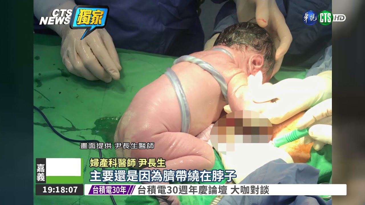 臍帶繞頸三圈 剖腹救女嬰一命