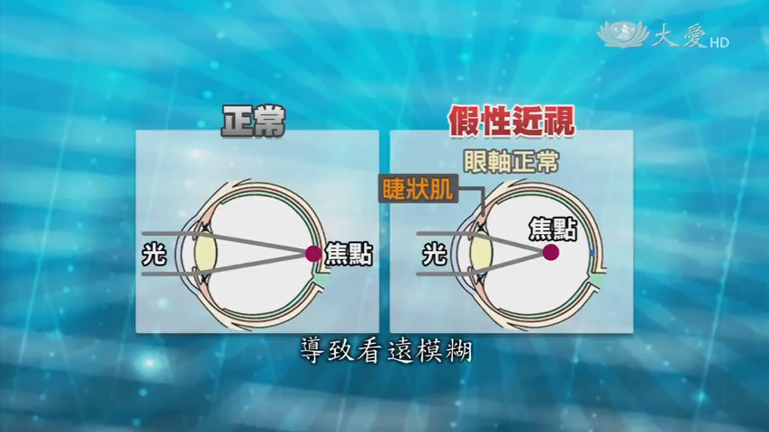 假性近視 判斷方式 爸媽們一定要了解的事情