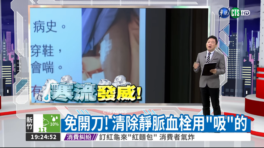 靜脈血栓 治療新術式 血栓抽吸技術免開刀