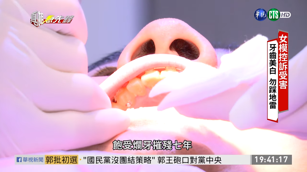 牙齒矯正與美白真的適合你嗎? 小心牙齦萎縮