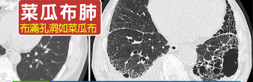 久咳不癒以為是感冒嗎? 小心可能是菜瓜布肺找上門